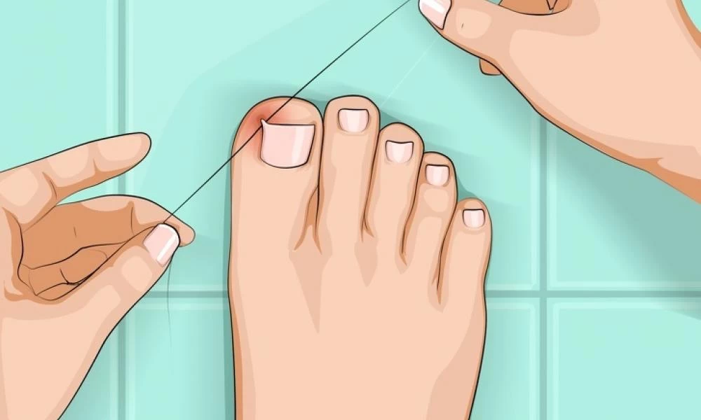 Νύχι μέσα στο δέρμα και πως να το αντιμετωπίσετε